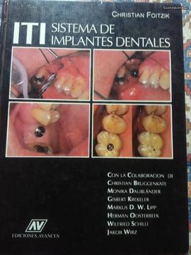 Sistema de Implantes Dentales